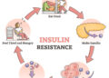 Insulin resistance test may help predict early Alzheimer’s cognitive decline rate