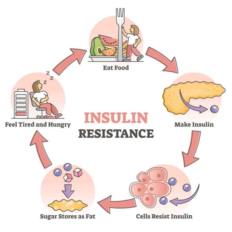 Insulin resistance test may help predict early Alzheimer’s cognitive decline rate